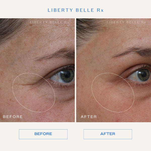 The Liberty Belle Rx Before & After Trial: Emily’s Skin Results