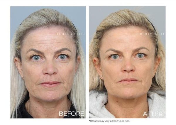 Mother of the bride - Non surgical Secrets blog post by Liberty Belle Rx - Woman before and after treatment with blonde hair and blue eyes